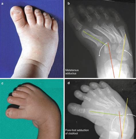 Common Foot Problems In Children Foot And Ankle