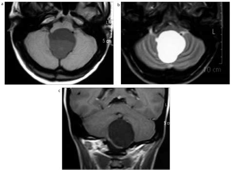 Neurenteric Cyst Of The 4th Ventricle Case Report And Short Review Of