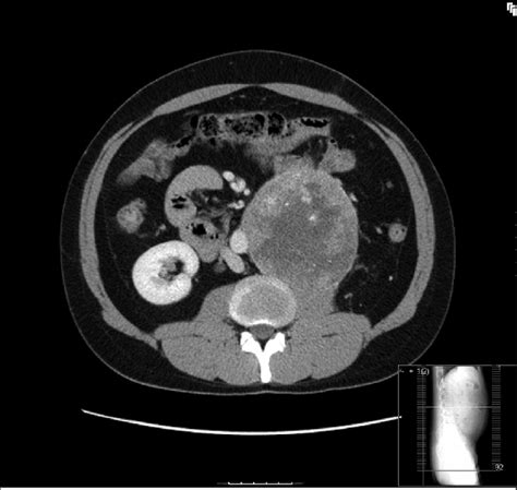 Ct Of A 27 Year Old Male Showing A Left Retroperitoneal Mass Closely