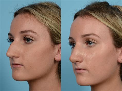 Rhinoplasty Before And After Photos Patient 585 Chicago Il Tlkm