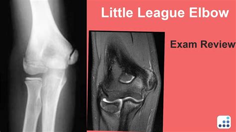 Little League Elbow Exam Review Christopher S Ahmad Md Youtube