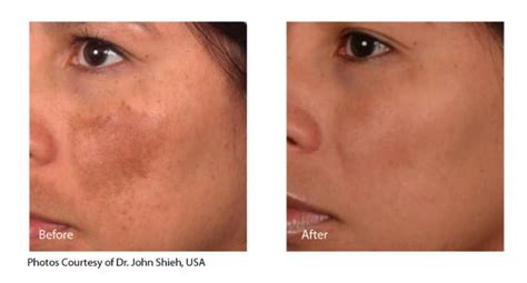 Melasma Treatment Inkfree Md Laser Clinic In Houston Tx