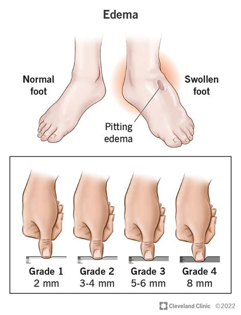 Pitting Edema What Is It Causes Grading Diagnosis Off
