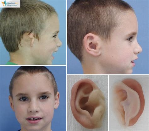 Ear Prosthesis Photos Medical Art Resources — Life Like Prosthetics