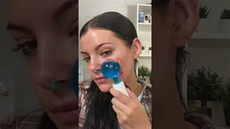 Satisfying Blackhead Relaxing And Pimple Popping Relaxing Acne Pimple