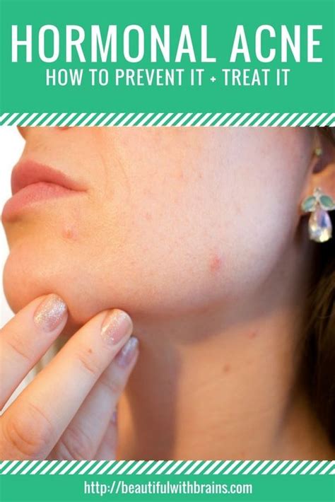 The Ultimate Guide To Dealing With Hormonal Acne Hormonal Acne Cheek