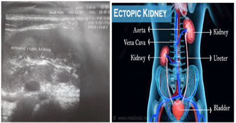Ectopic Kidney A Case Report On Sonographic Finding