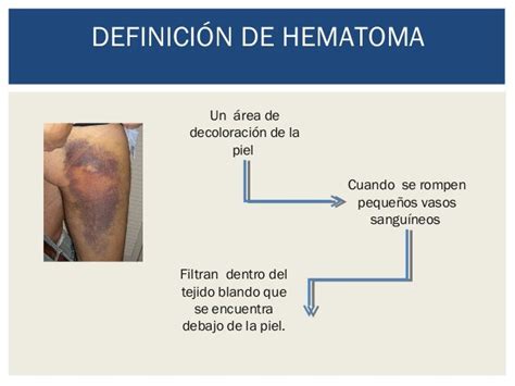 Hematomas Marlene