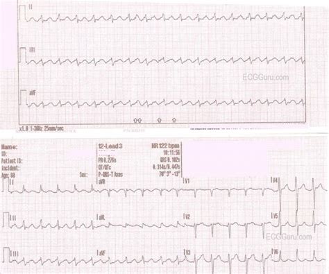 Atrial Flutter With 21 Conduction Ecg Guru Instructor Resources
