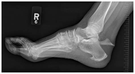 Avulsion Fracture Of The Calcaneus Cmaj