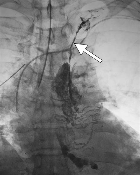 Percutaneous Thermal Ablation For Refractory Thoracic Duct Leak After