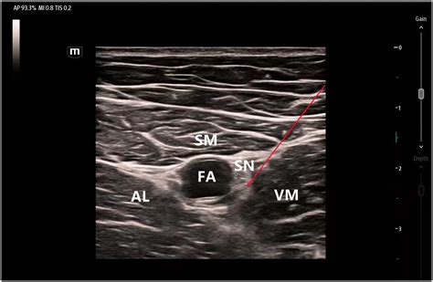 Minimum Effective Concentration Of Ropivacaine For Ultrasound Guided