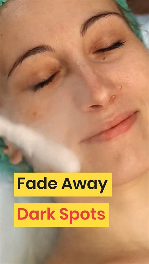 How To Fade Dark Spots Naturally Video In 2020 Dark Spots On Face