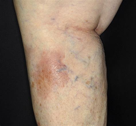 Atypical Clinicopathologic Presentation Of Primary Cutaneous Diffuse