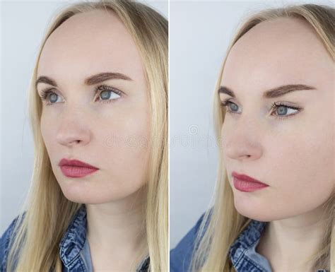 Fox Eye Lift Before And After On Left Is A Girl With Normal Eyes And On Right Is After An