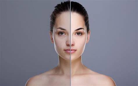 Uneven Skin Tone Causes Treatment Bodywise