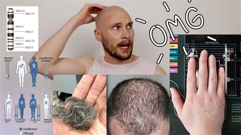 What Are The Early Signs Of Male Pattern Baldness Youtube