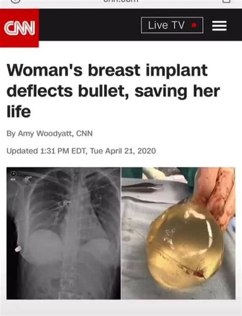 Womans Breast Implant Deflects Bullet Saving Her Life By Amy Woodyatt Cnn Updated 131 Pm Edt