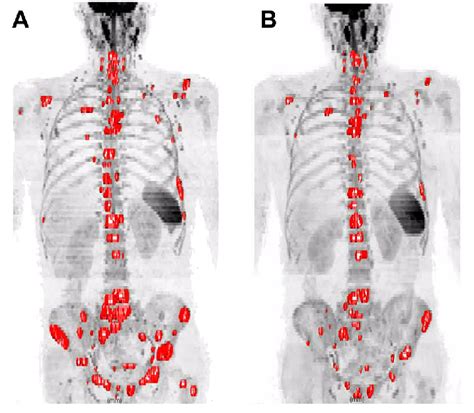 Whole Body Diffusion Weighted Images In A Woman With Metastatic Breast