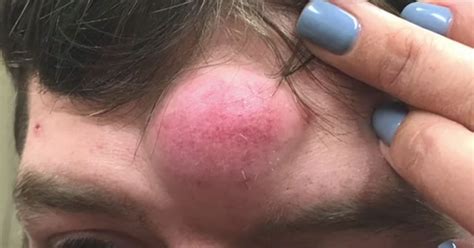 Gross Pimple Popping Video Proves Unicorn Cysts Are Real Huffpost
