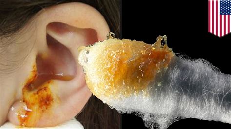 Removing Ear Wax Cleaning Ears With A Q Tip Is Bad For You Bad For Ear Health Tomonews Youtube
