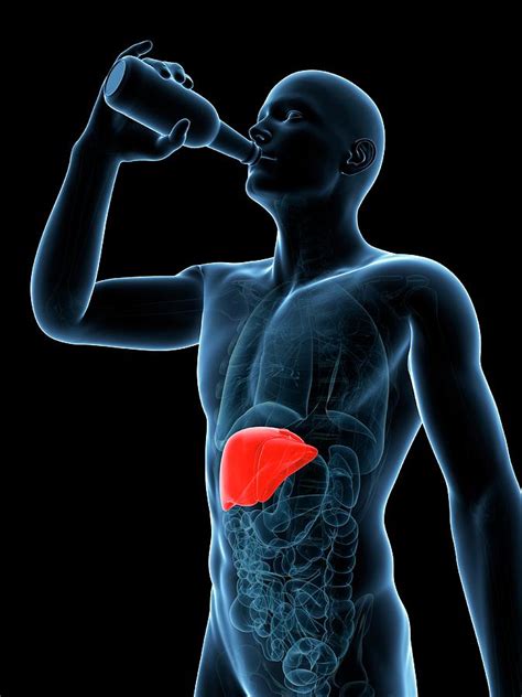 Alcoholic Liver Disease Photograph By Sciepro Science Photo Library Pixels
