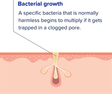 Severe Nodular Acne Accutane