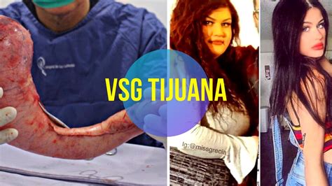 Weight Loss Surgery In Tijuana Youtube
