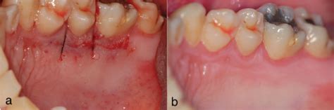 Management Of The Palatal Donor Area After Harvesting A Connective