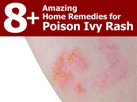 8 Amazing Home Remedies For Poison Ivy Rash