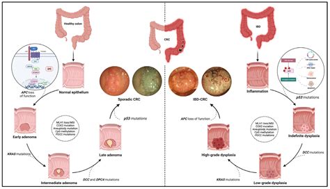 Cancers Free Full Text Inflammation Driven Colorectal Cancer