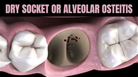 Dry Socket Or Alveolar Osteitis Youtube