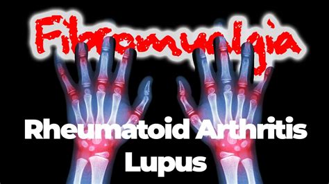 Fibromyalgia Rheumatoid Arthritis And Lupus Youtube