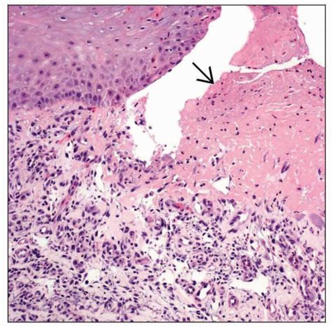 Chondrodermatitis Nodularis Helicis Basicmedical Key