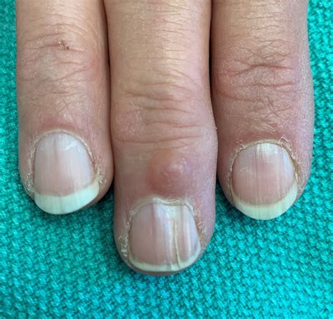 Cancer Bumps On Fingers