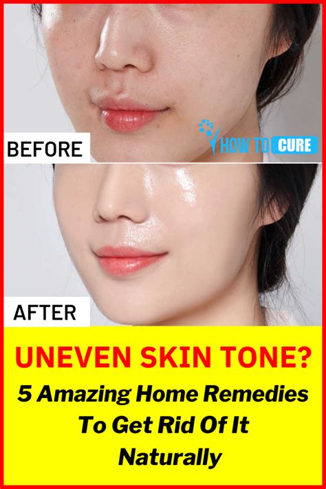 5 Simple Natural Ways To Get Rid Of Uneven Skin Tone Howtocure Even