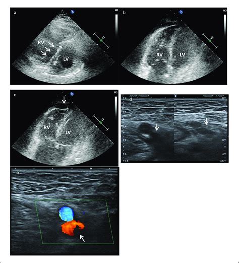 Point Of Care Ultrasound Pocus Findings After Thrombolytic Therapy