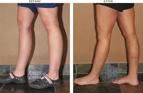 Calf Augmentation Before And After Pictures Dr Turowski Plastic Surgery Chicago