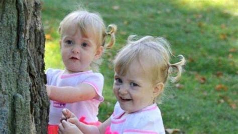 Once Conjoined Twins Thrive After Surgery Conjoined Twins Twins After Surgery