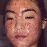Is Laser Treatment Good For Acne Photos