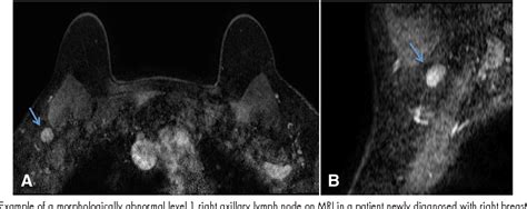 Figure 6 From Imaging Axillary Lymph Nodes In Patients With Newly
