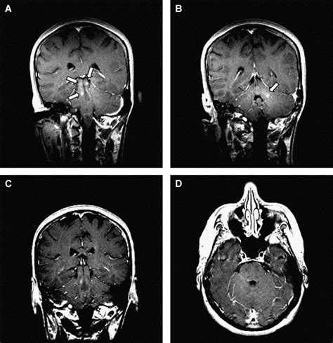 Acyclovir Responsive Brain Stem Disease After The Ramsay Hunt Syndrome