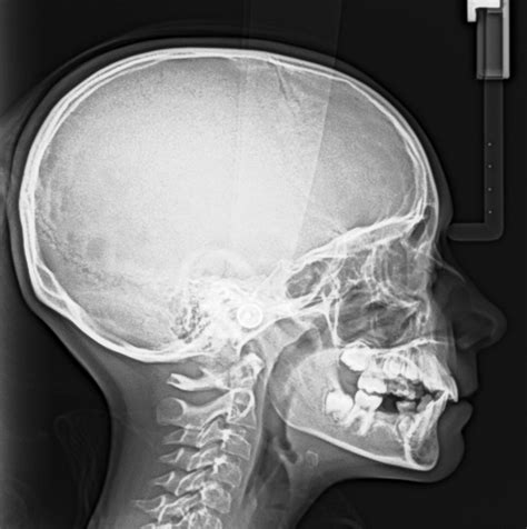 Indicaciones De La Radiografía Lateral De Cráneo Dento Metric