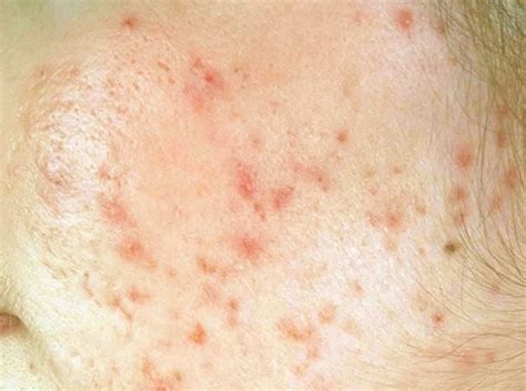 Liver Disease Spots On Skin