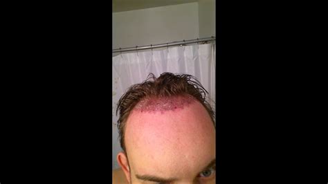 Hair Transplant Post Op Pics Best Hairstyles Ideas For Women And Men In 2023
