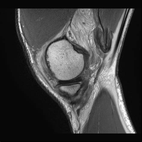 Hyperextension Knee Injury Posteromedial And Posterolateral Corner Injuries Image