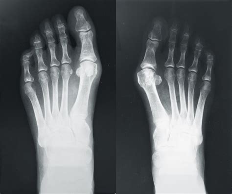 X Rays After Bunion Surgery Predict Risk Of Recurrence Wimbledon Clinics