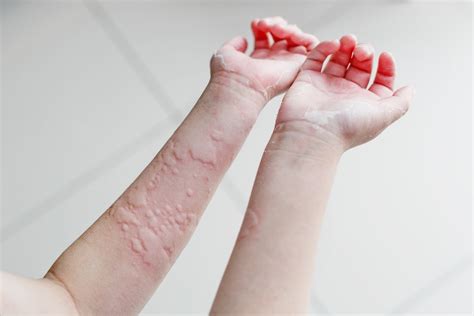 Urticaria What It Is Symptoms And Main Causes