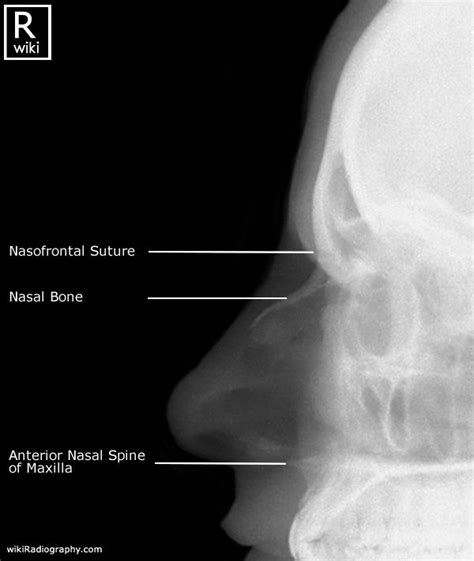 Nasal Bones Radiographic Anatomy Medical Radiography Radiology
