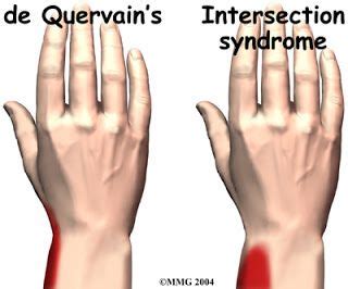 De Quervain S Tenosynovitis Occupational Therapy Treatment